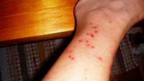 Má kousnutí kousnutí? Rozhodně! Ale s tím můžete vyrovnat